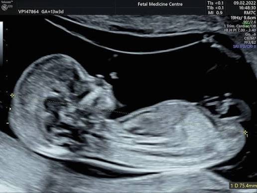 Nuchal translucency scan for pregnancy screening in Pune